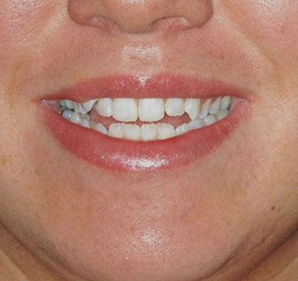 teeth that do not meet