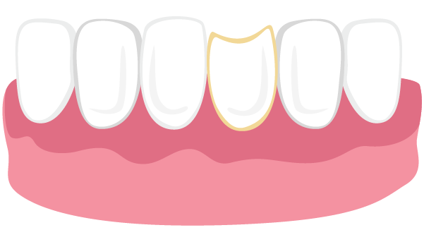 Illustration of a chipped tooth