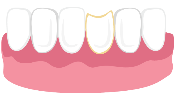 Illustration of a chipped tooth