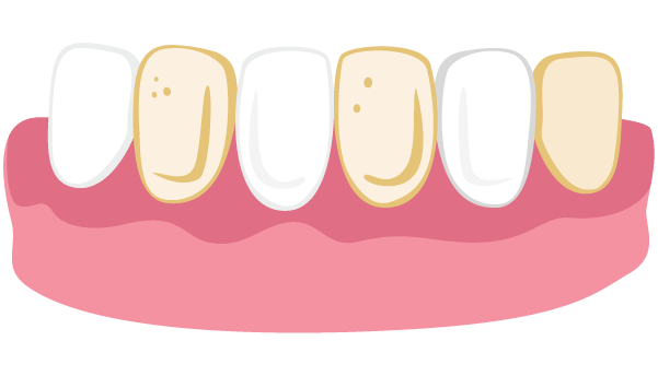 Illustration of stained teeth