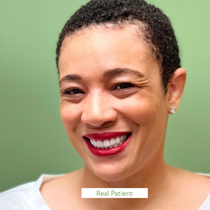 man wearing invisalign