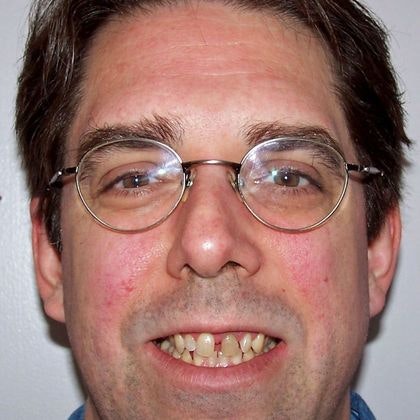 Patient with worn and stained teeth