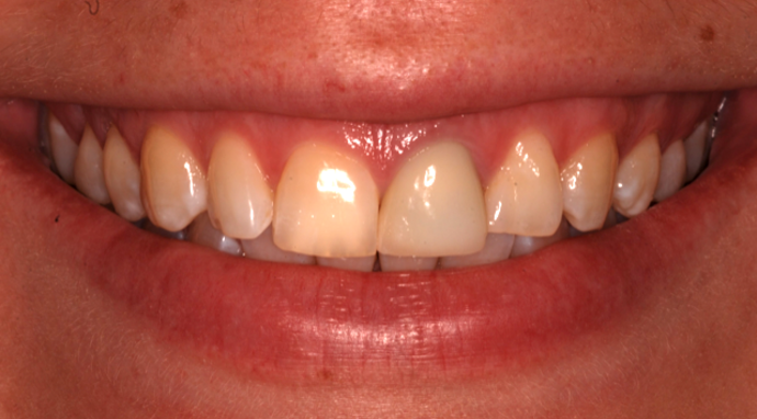 before smile makeover