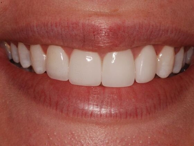 Perfectly white teeth after professional whitening