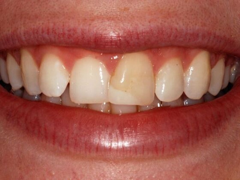 Discolored front tooth and yellowing of surrounding teeth