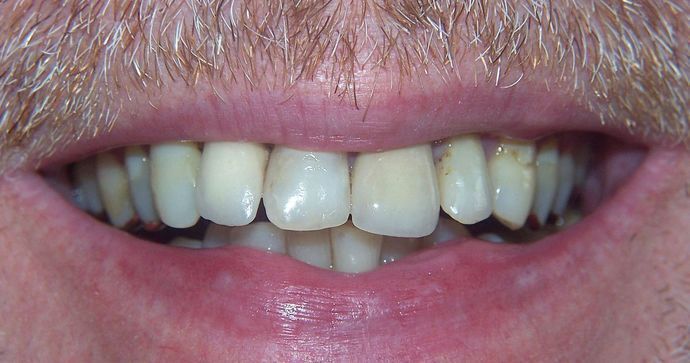 Dr. N. Summer Lerch's Patient Before Full Mouth Reconstruction