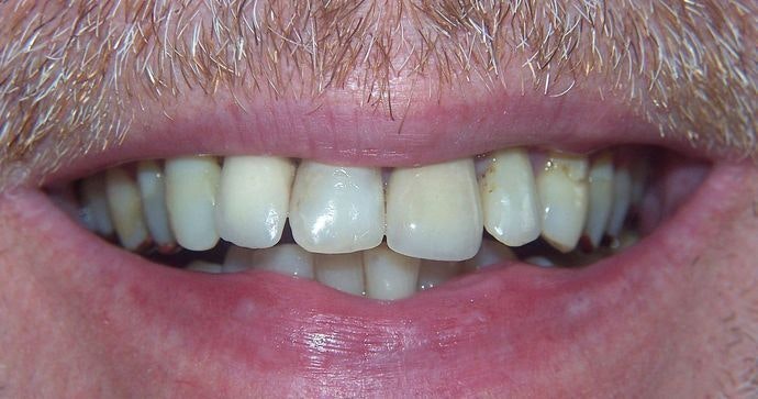 Dr. N. Summer Lerch's Patient Before Full Mouth Reconstruction