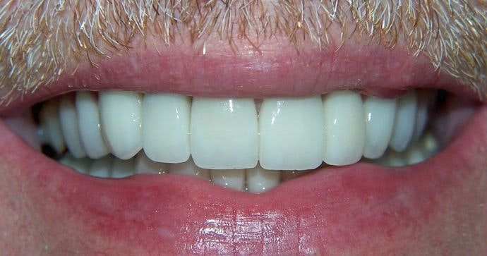 Dr. N. Summer Lerch's Patient After Full Mouth Reconstruction