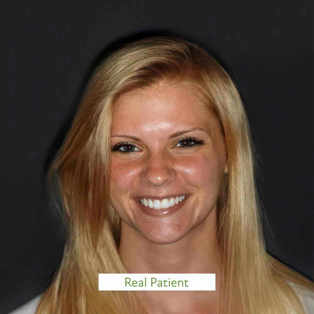 Amber (real patient) after crowns restoration