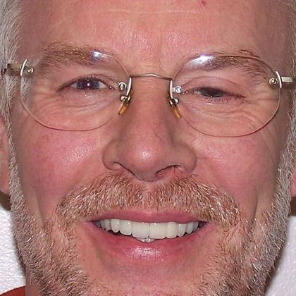 Dr. N. Summer Lerch's Patient After Dental Crowns