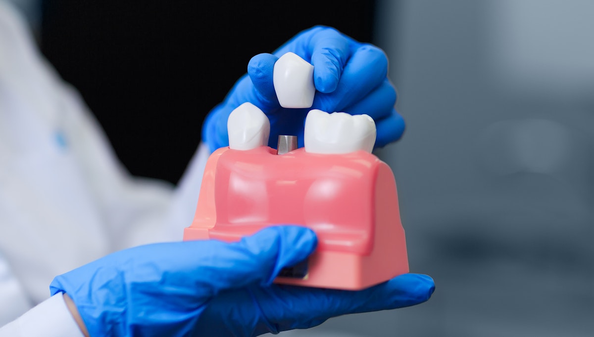 Gloved hand holding dental model to demonstrate crown placement
