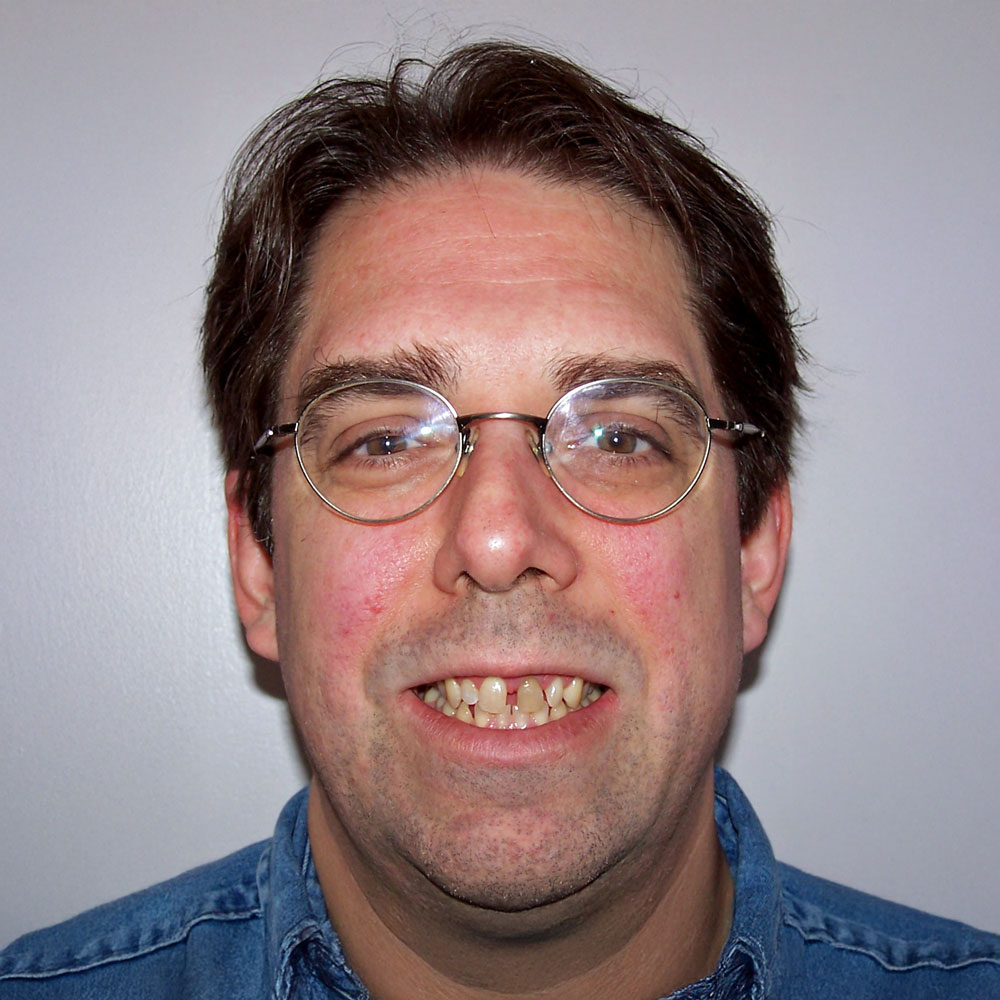 Patient with worn and stained teeth