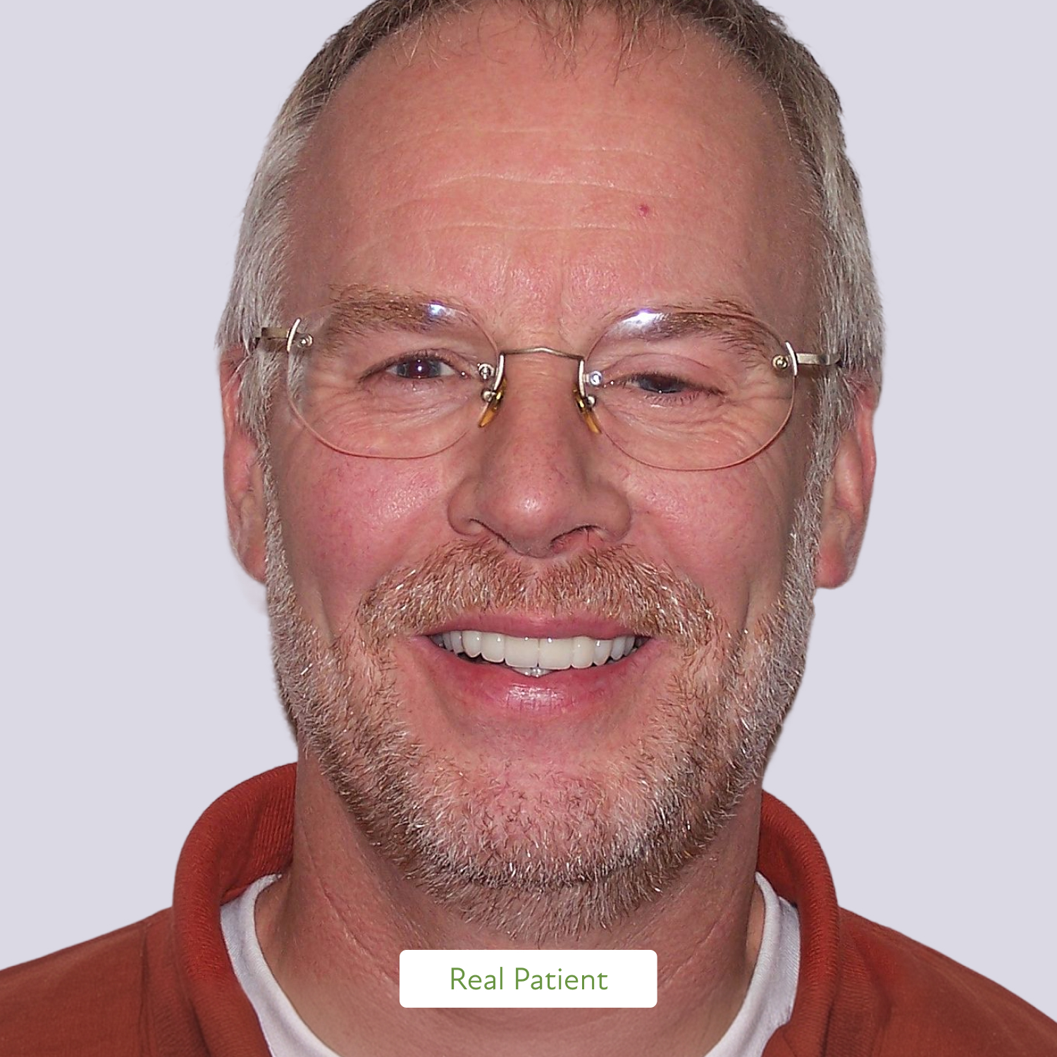 Implant-supported dental restoration on a model