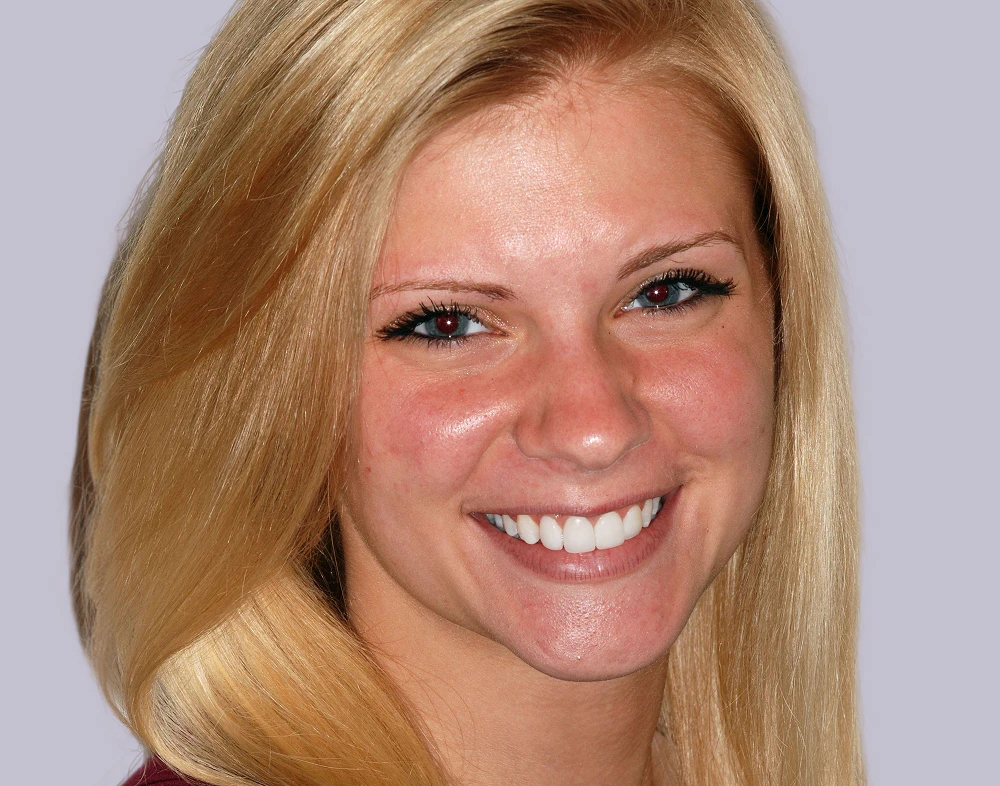 patient with veneers