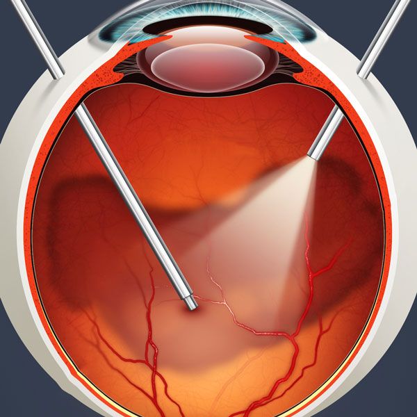 Vitrectomy
