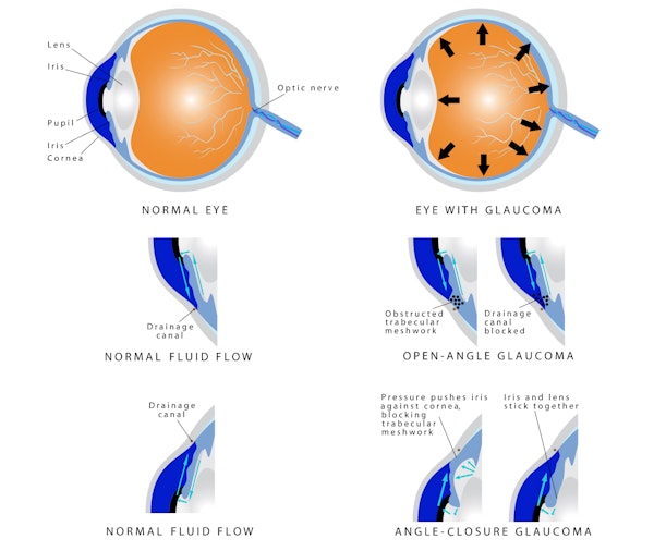 Glaucoma diagrams