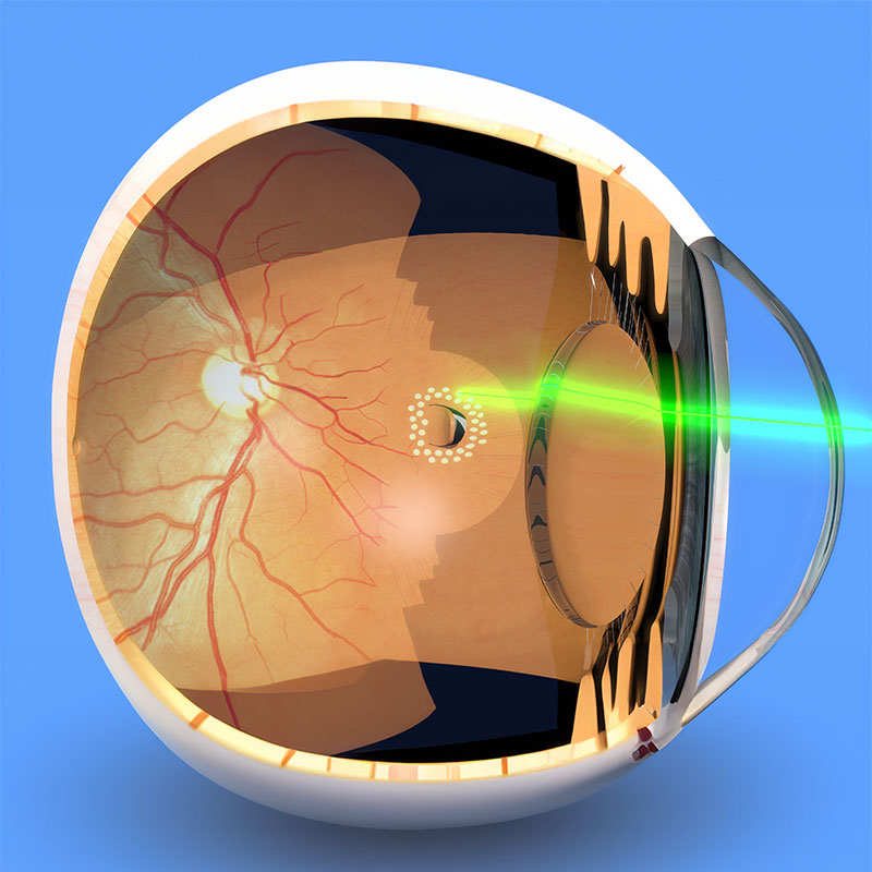 Focal Laser Treatment (Photocoagulation)
