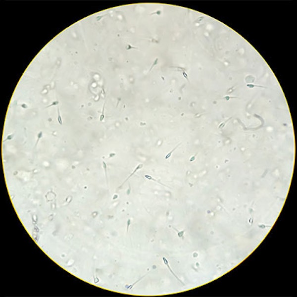 Microscope image of low sperm count