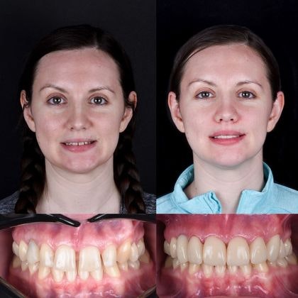 Before and after veneers