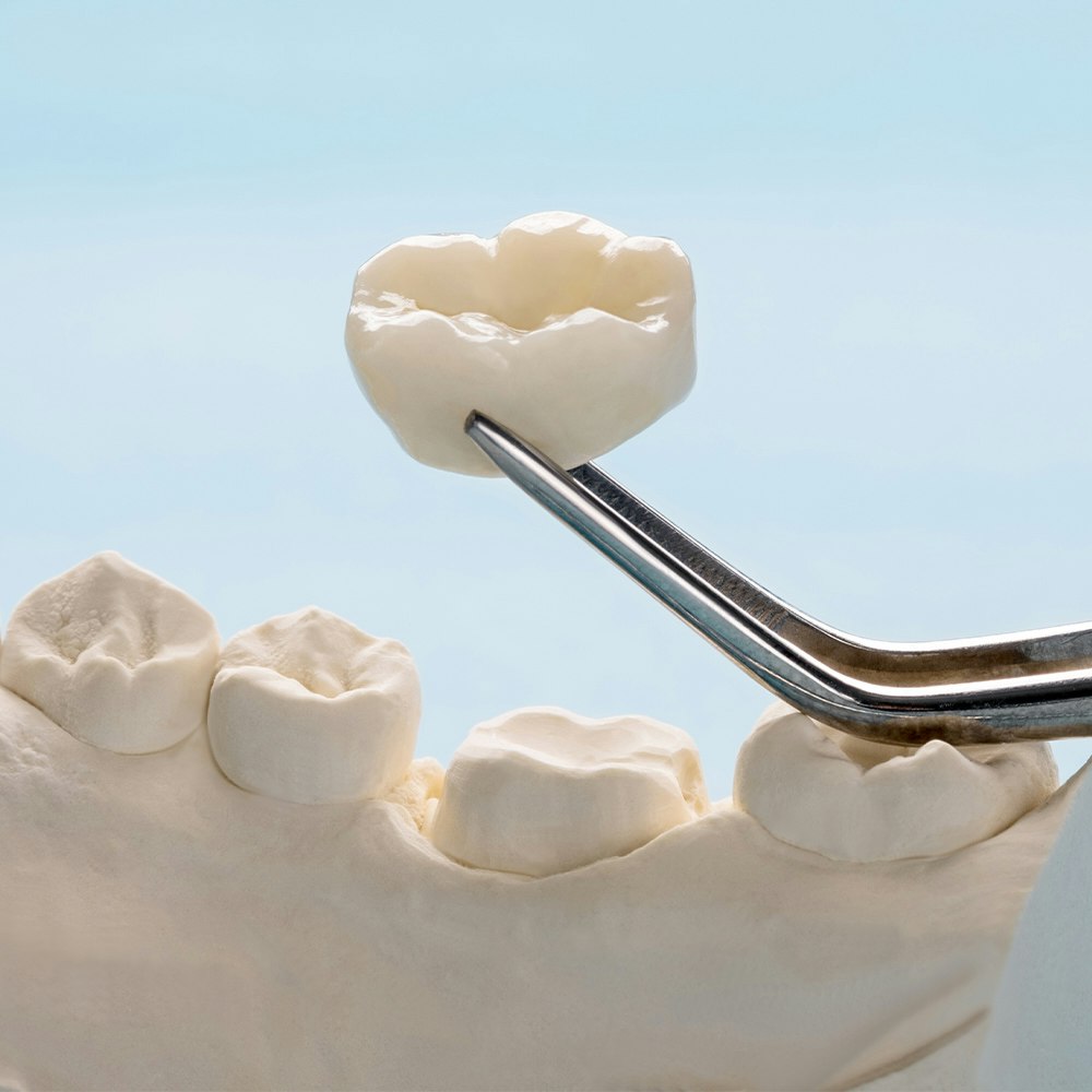 Dental Crowns