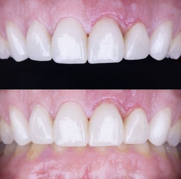 Patient After Veneers in Los Algodones