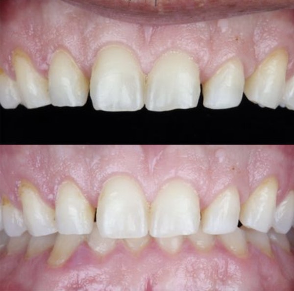 Patient Before Veneers at our Los Algodones dental practice