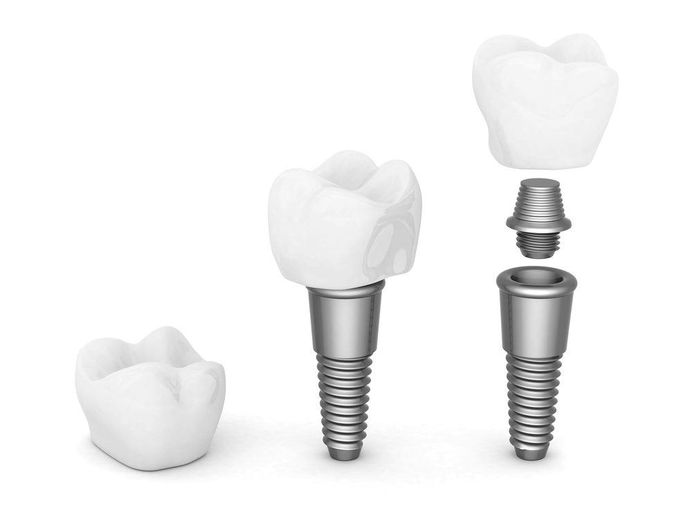 Parts of a dental Implant
