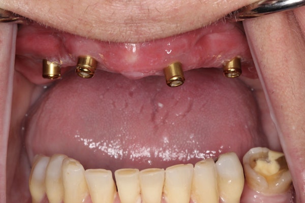 A Cosmetic and Implant Dentistry of Connecticut Patient Before Implants