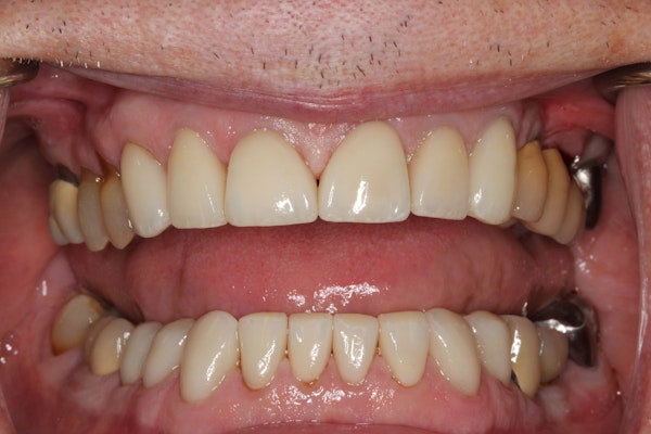 A Cosmetic and Implant Dentistry of Connecticut Patient After Implants