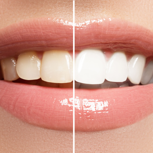 Smile before and after teeth whitening