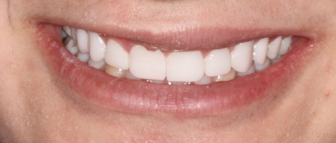 After Veneers