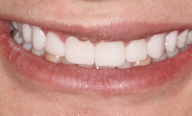 After Veneers