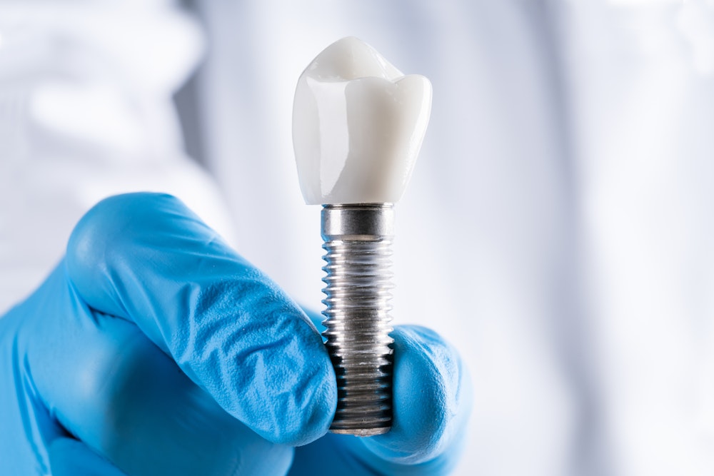 dental implant and crown