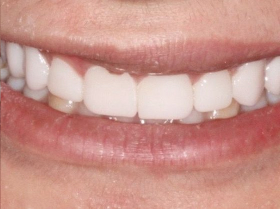 After veneers placement