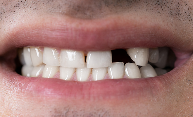 Smile with missing tooth