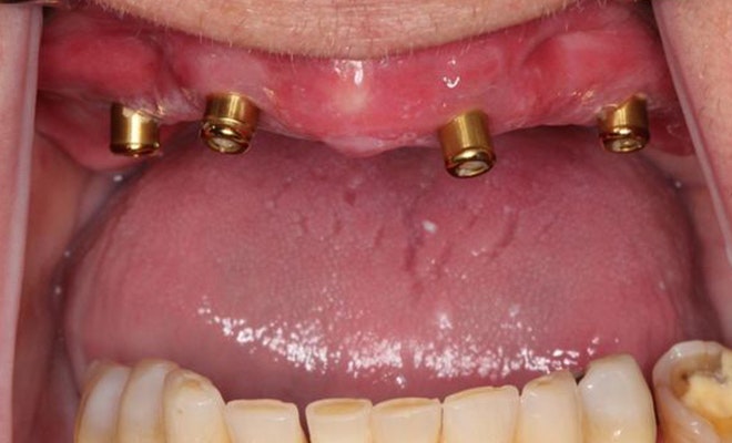 Before Dental Implants