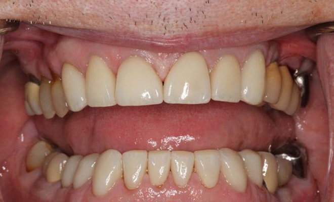 After Dental Implants