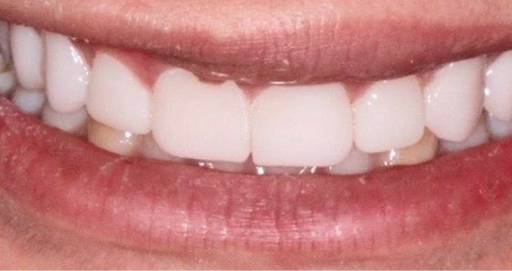 after smile transformation