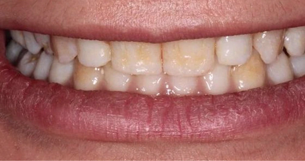 before smile transformation