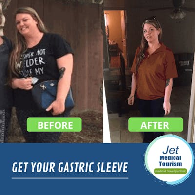 Gastric Sleeve Before and After Pictures: Best VSG Photos (2022)