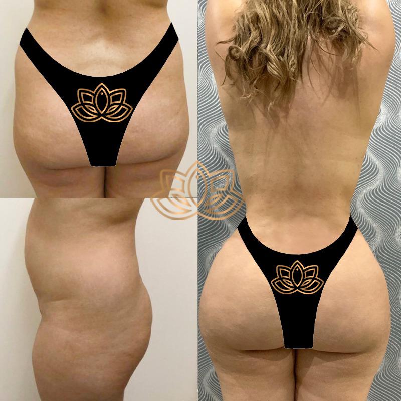 Brazilian Butt Lift