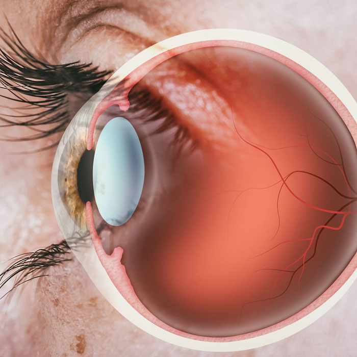 Depiction of Retinopathy