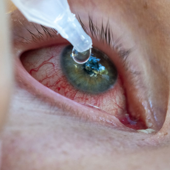 Eyedrops and pink eye