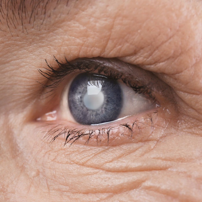 Close-up of eye with cataract