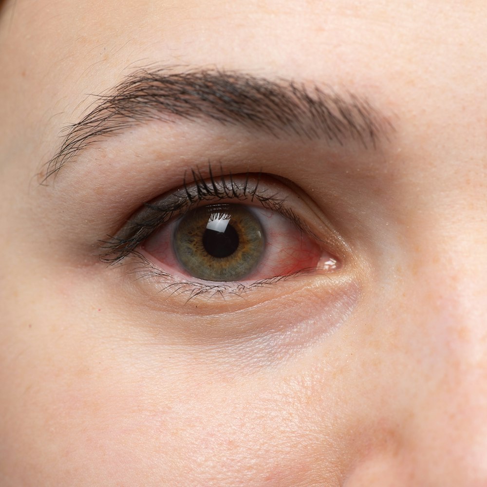 Close-up of red, irritated eye