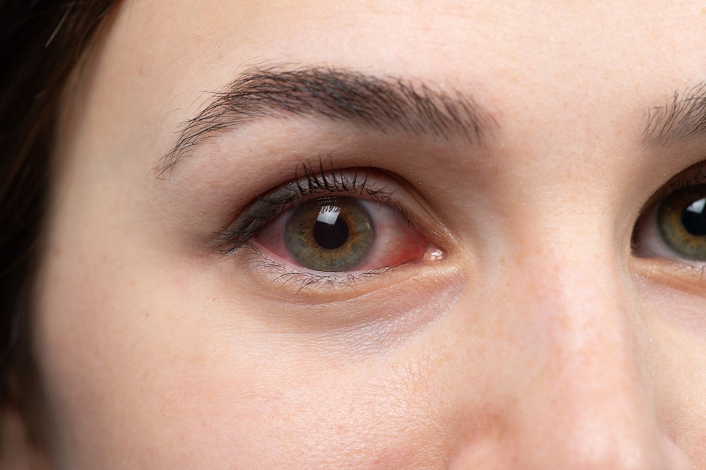 Close-up of red, irritated eye