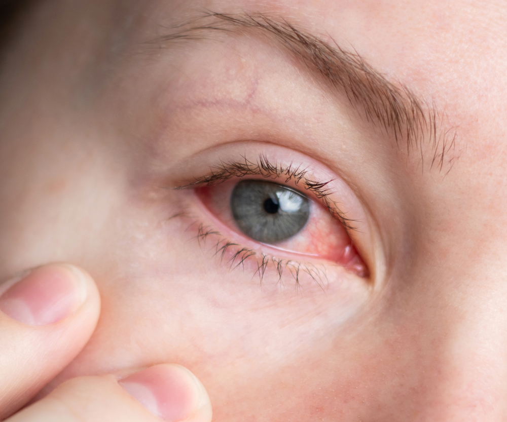 Pink eye