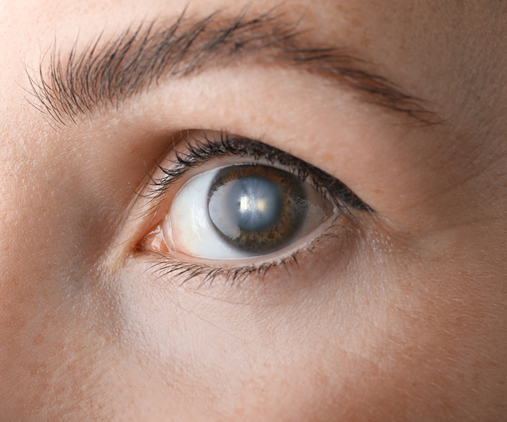 Eye with cataract