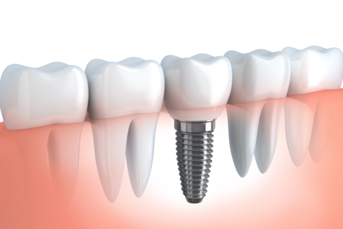 Implant-supported crown