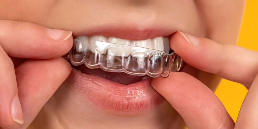 Invisalign